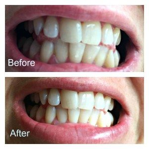 Whiten Your Teeth At Home With Smile Brilliant - Saving You Dinero